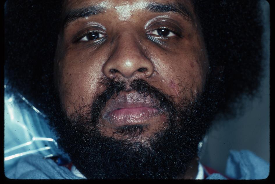 Prognosis and treatment