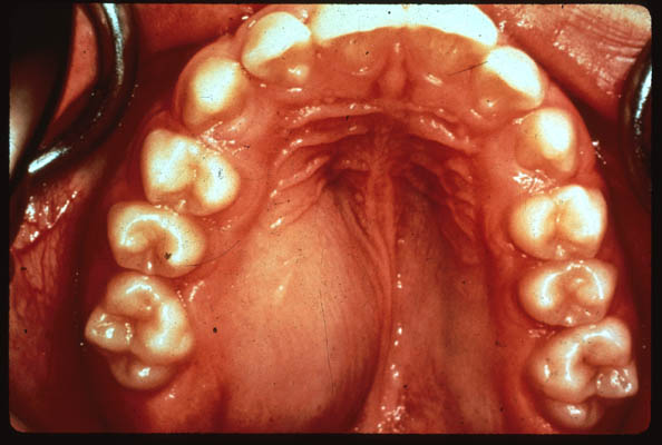 Photo of roof of mouth with swelling