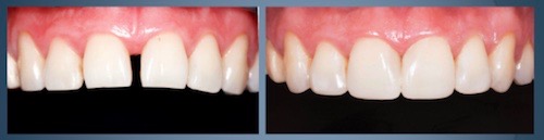 Before and After Photo of Erin Wang's Aesthetic Case Study for the Dentsply Sirona Restorative Global Clinical Case Contest