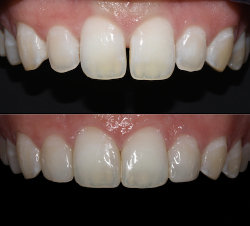 Before and After Photo: Dr. Jenna Chimon's Aesthetic Case Study for the Dentsply Sirona Restorative Global Clinical Case Contest